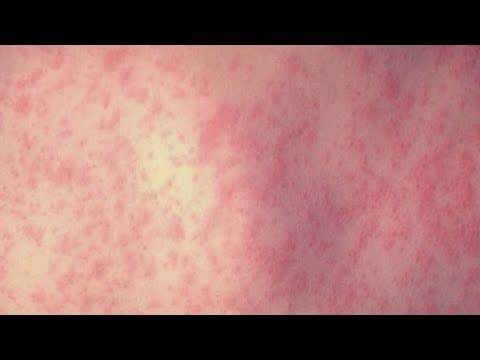 Latest on measles outbreak in Texas