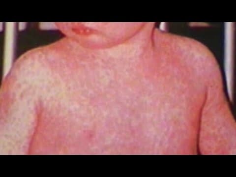 Local children with measles not vaccinated, Louisiana Department of Health says