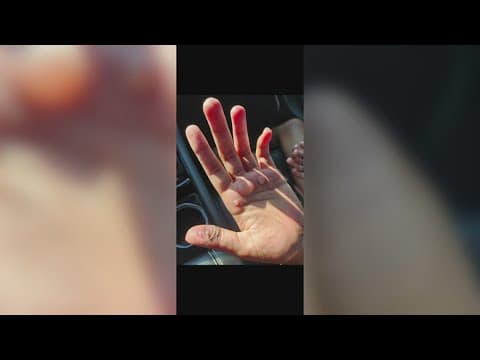 2 Warren Central students suffer second-degree burns after dance practice punishment