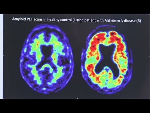 Dementia cases could double by 2060, health officials say