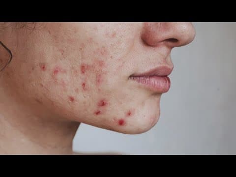 Halloween is next week! Here's how candy can affect your skin