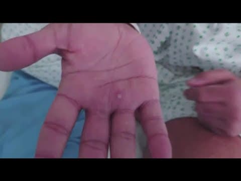 Monkeypox declared public health emergency in San Diego County