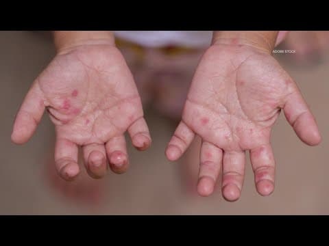 West Texas measles outbreak grows past 500