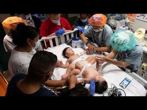 Parents pray before conjoined twin sons separated at Texas Children's in Houston