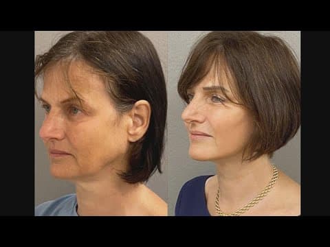 Everything you need to know about the facelift process