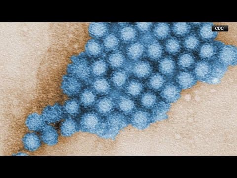 Stomach bug causing sudden vomiting, diarrhea surges in US