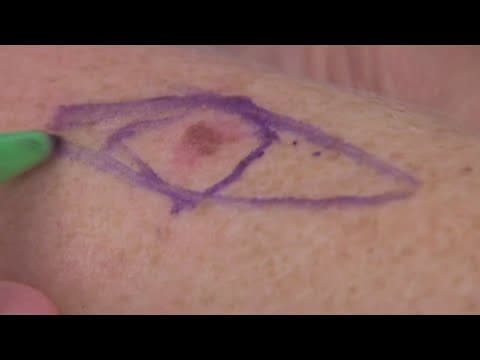 Doctors debunk skin cancer misconceptions, myths