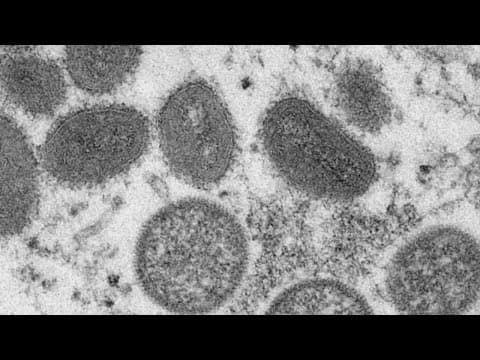 Columbus Public Health investigating local case of monkeypox