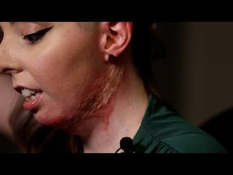 Dallas couple sues bar after fiery drink left them with 3rd-degree burns