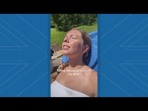 Why 'sunburning' is not the answer for clearing up acne