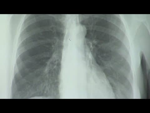 Louisiana ranks among worst for lung cancer survival rates