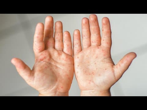 McCutcheon High School pauses freshman football due to hand, foot and mouth disease