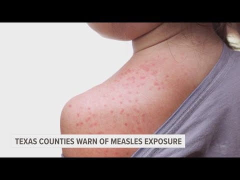 Texas measles outbreak: Officials expected  to provide update