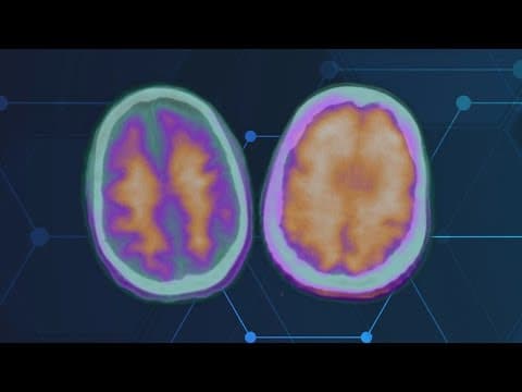 Health Matters: UTHealth neurologist leads groundbreaking Alzheimer's drug trial