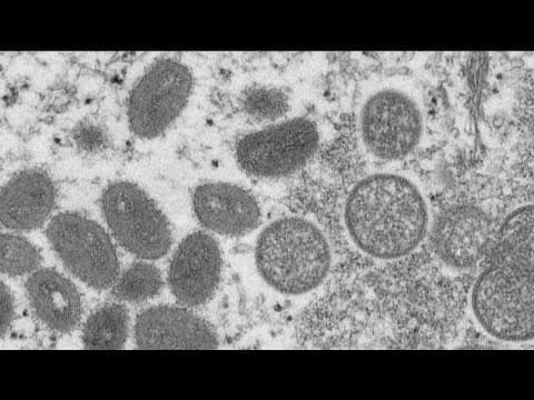 San Diego County issues advisory about Monkeypox ahead of Pride weekend festivities