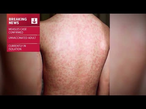 First measles case of 2025 confirmed in Greater New Orleans Area, linked to international travel
