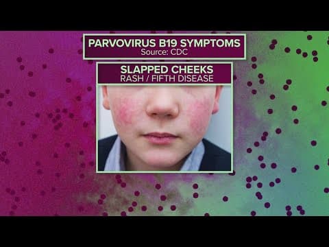 CDC issues health advisory for increase in human parvovirus cases