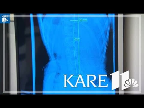 Scoliosis signs every parent should know about