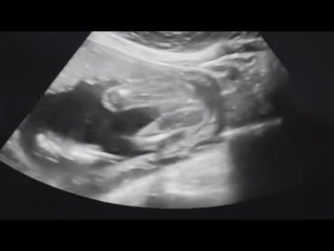 Texas bill to clarify exceptions to state's abortion ban clears key hurdle after rocky path