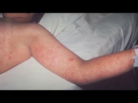 Experts warn of illnesses, viruses as students return to school