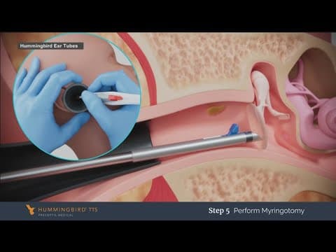 FDA clears 'hummingbird' to help those who need ear tube procedure for frequent ear infections