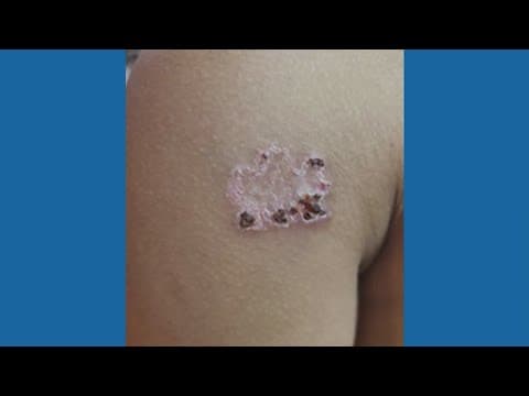 Man sues Houston-area temple after he said his son was branded on both shoulders during ceremony