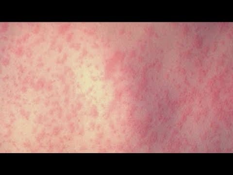 San Diego health officials on alert after first measles death in a decade