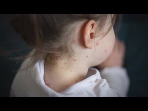 Texas measles case update expected today