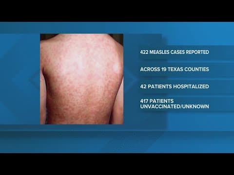 Measles cases continue to surge in Texas outbreak