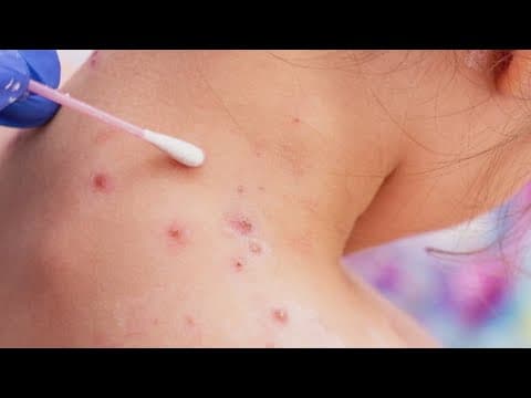 CDC issues new travel warning as measles cases surge
