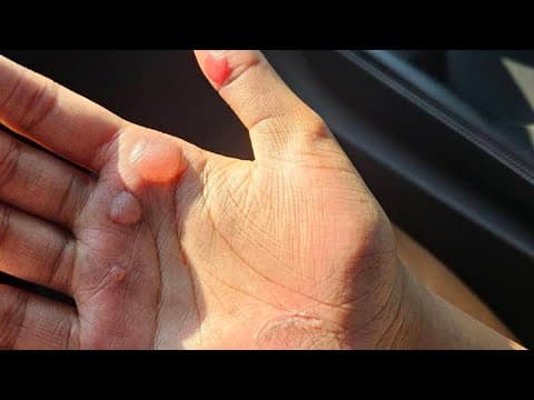 Coach resigns after 2 Warren Central students suffer second-degree burns after dance practice